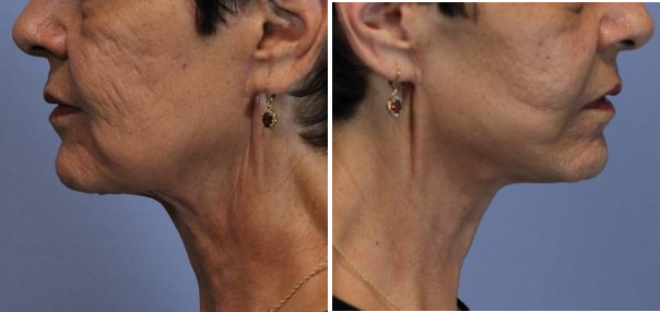 neck-lift-post