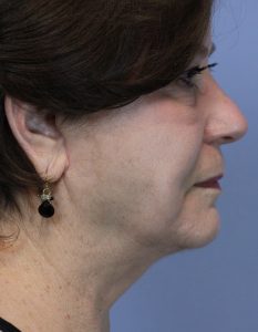 After sagging neck lift 